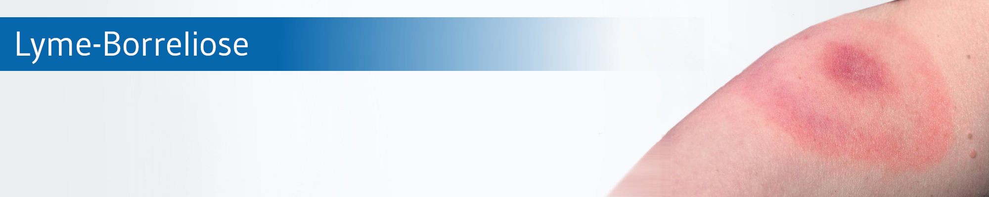 Die-GPK-informiert_Lyme-Borreliose